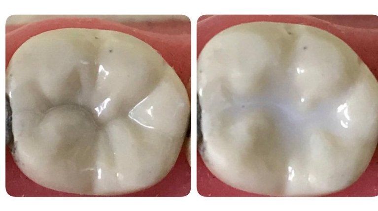 Dental Sealants in Vasant Kunj